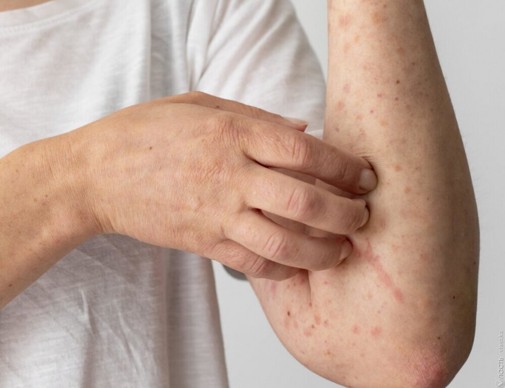 Почти 2,8 тыс. случаев кори зарегистрировано в Казахстане с начала года – Минздрав