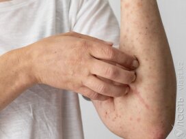 Почти 2,8 тыс. случаев кори зарегистрировано в Казахстане с начала года – Минздрав